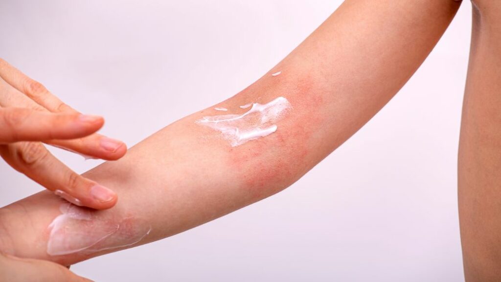 Get Dermatitis Treatment Online
